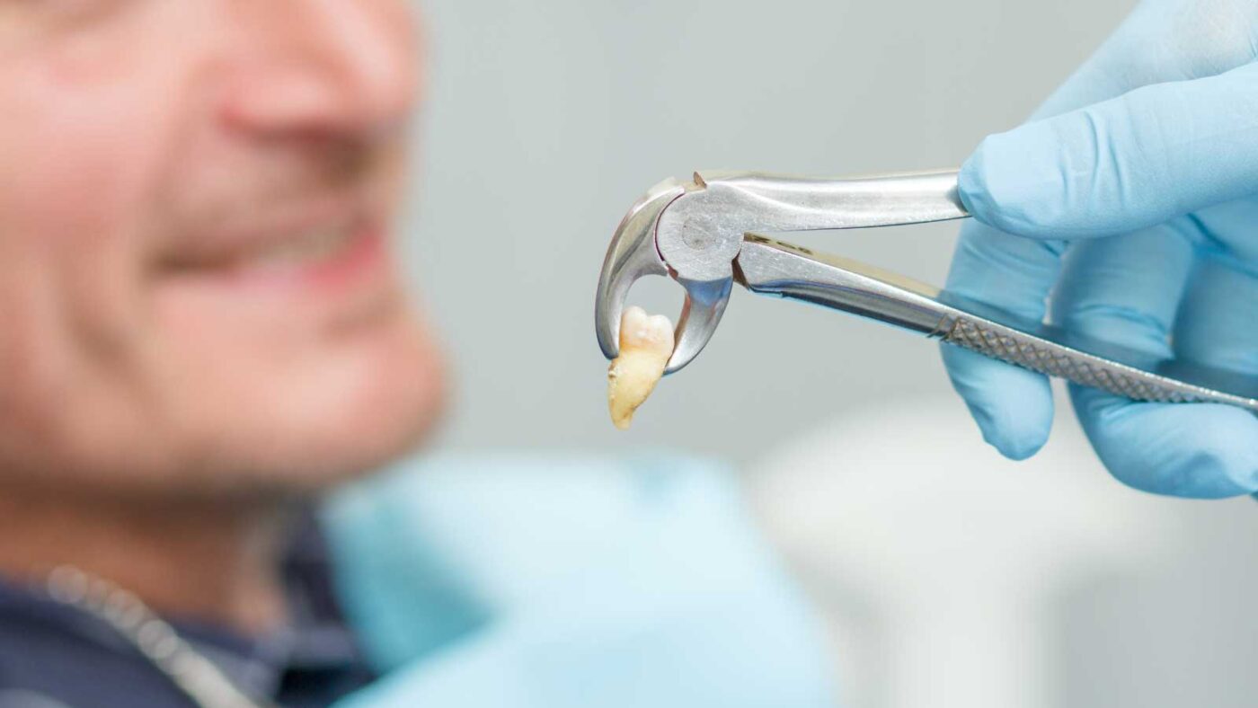  A dentist holds a freshly extracted tooth with forceps.