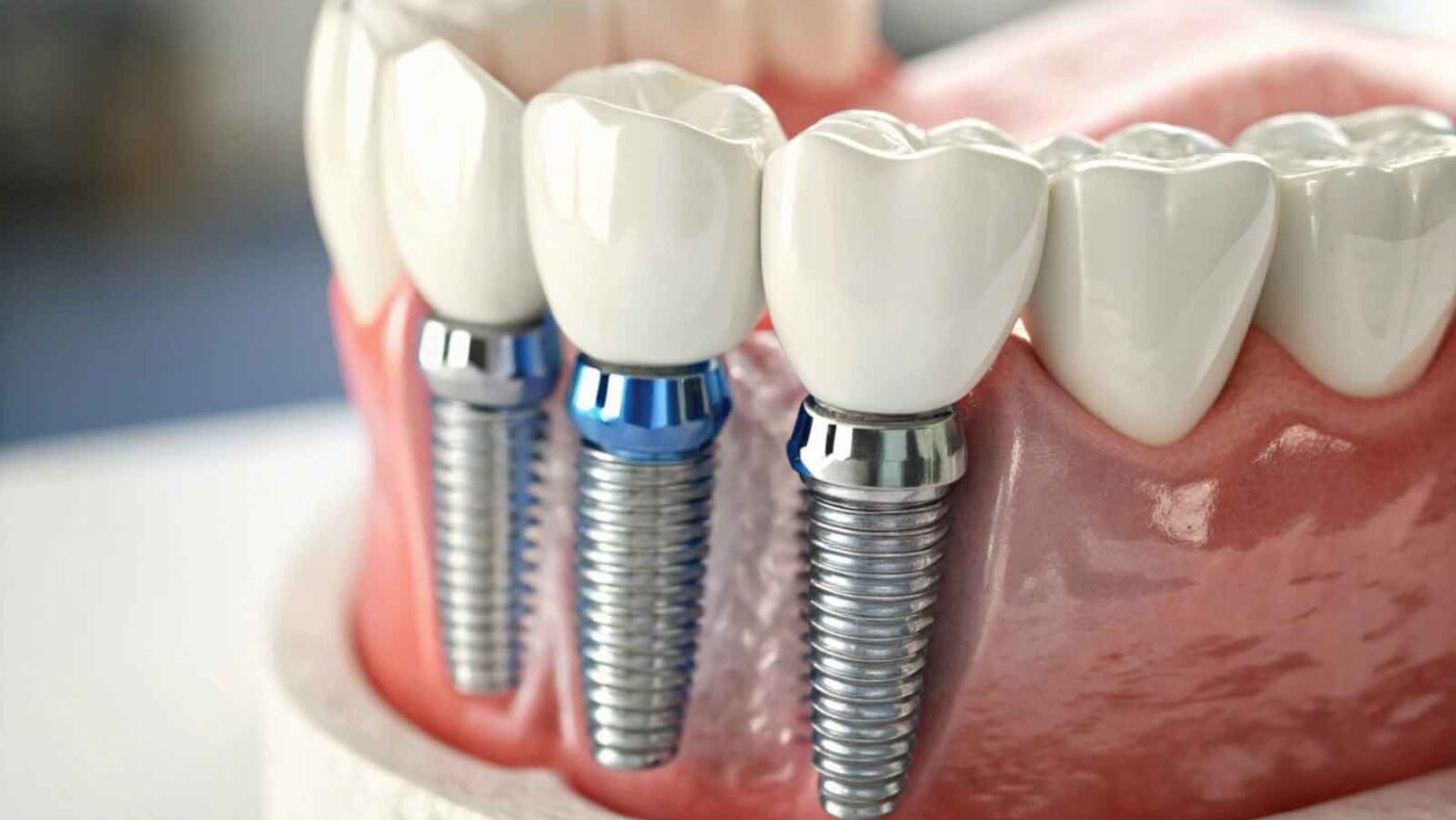 Dental implants supporting artificial teeth in a model of the jaw.