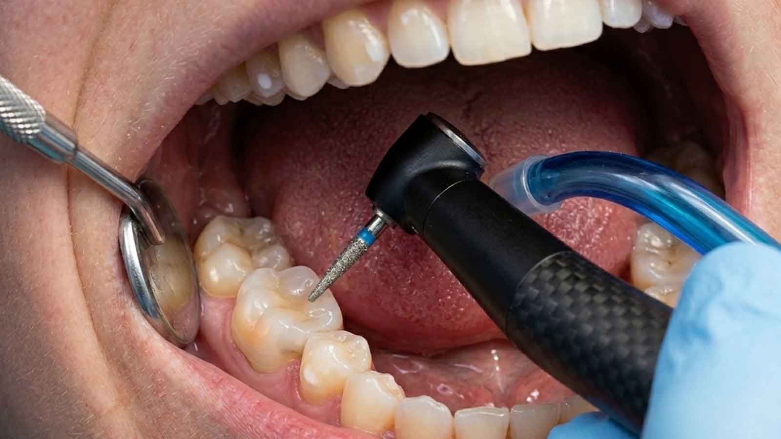 Close-up view of an endodontic procedure.