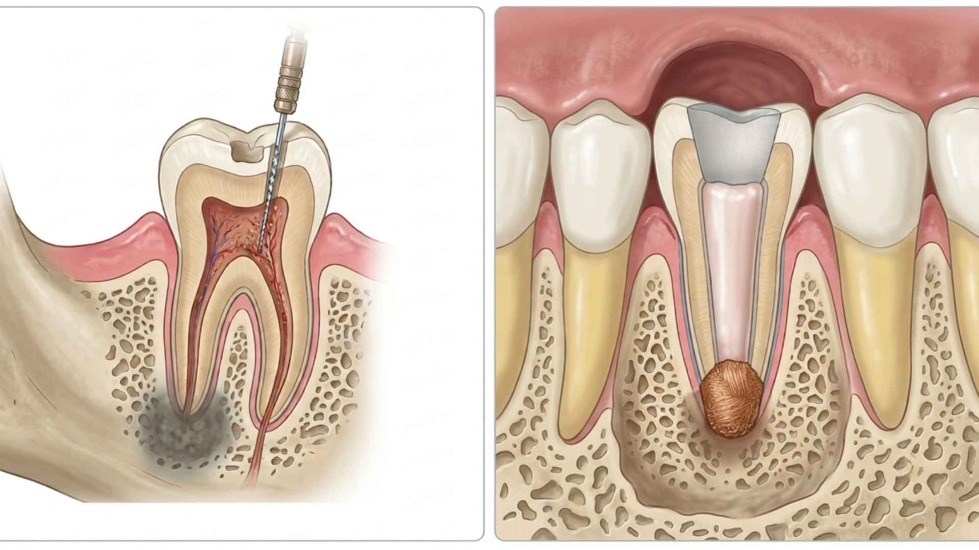 Comparison of Apicoectomy and Root Canal Retreatment Procedures