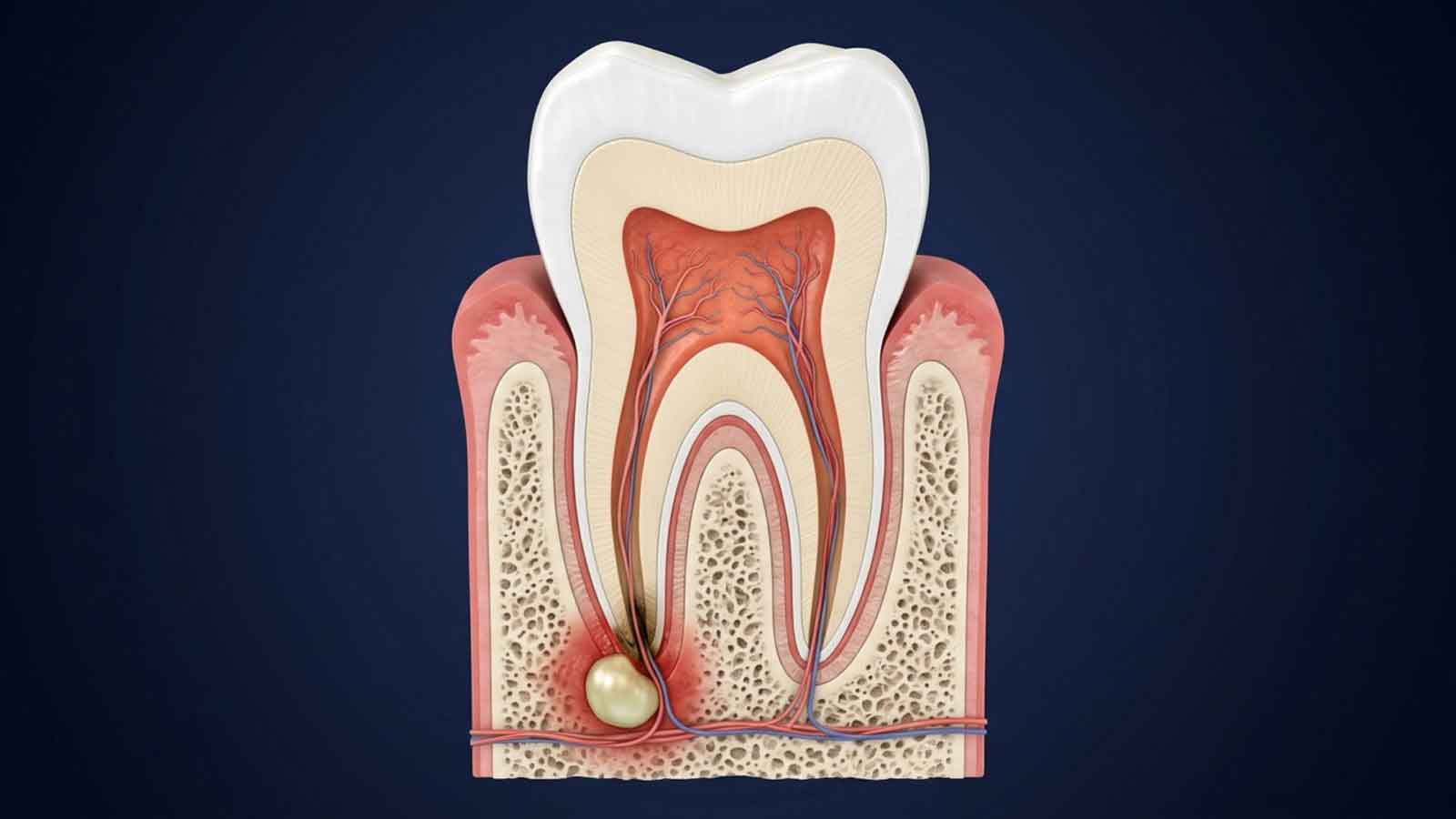 Dental illustration showing tooth anatomy and an infected area at the root tip.