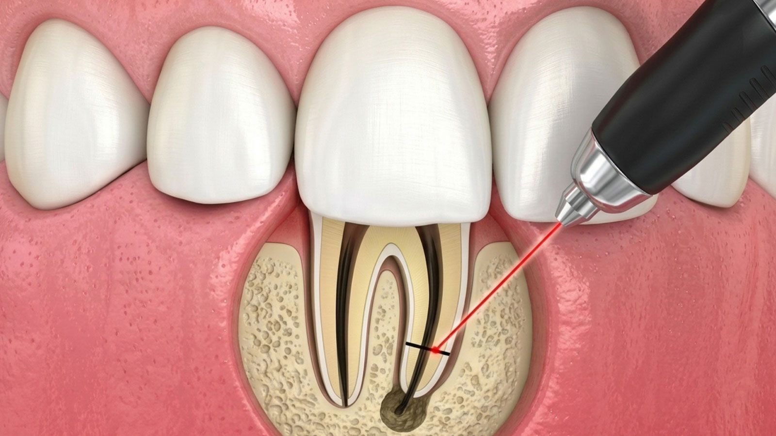 Dental illustration showing an apicoectomy procedure treating the tip of a tooth root.