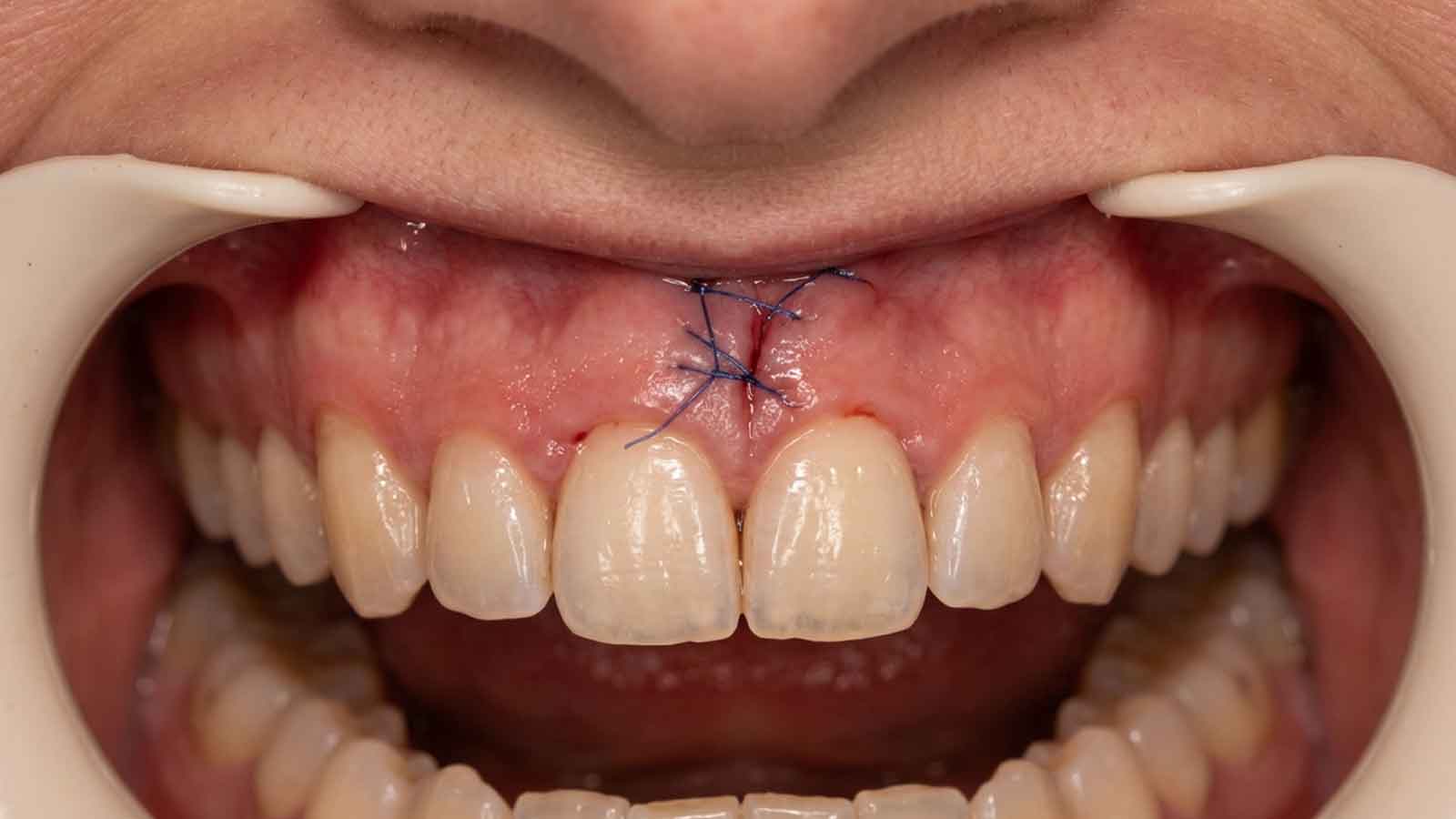 Monitoring Healing After an Apicoectomy