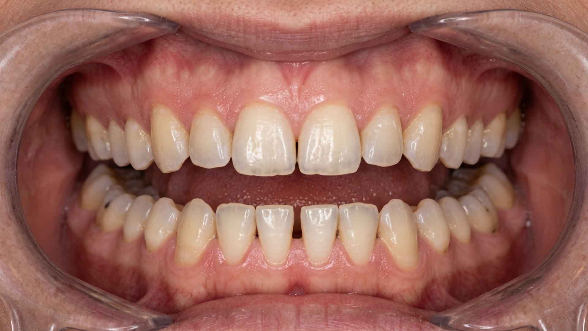 Close-up of a patient's teeth and gums showing changes that may require endodontic evaluation after an apicoectomy.
