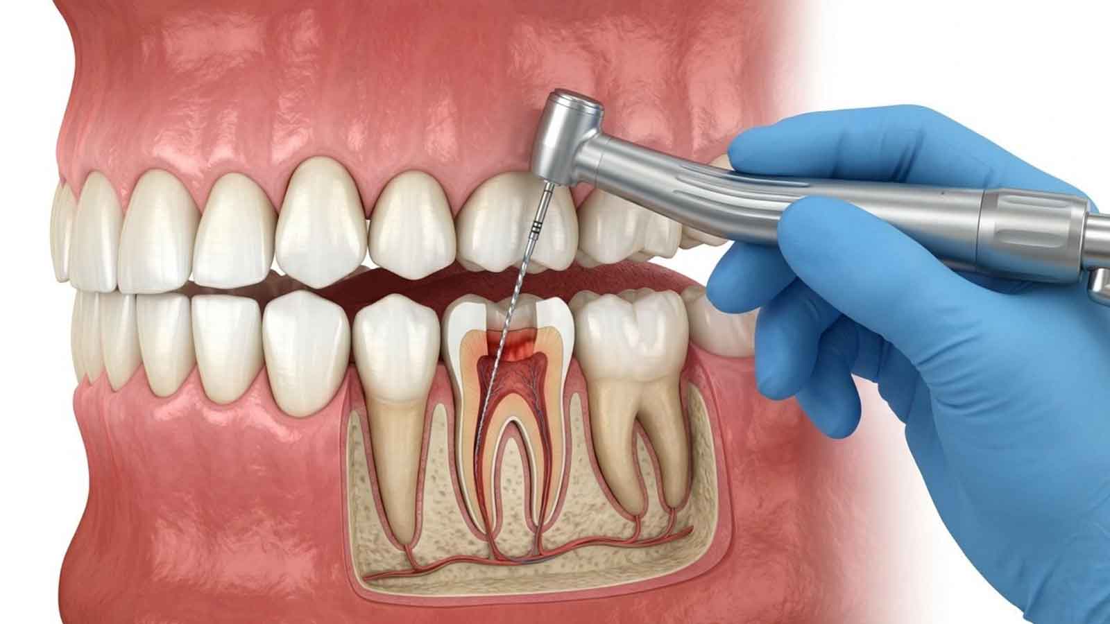 Dental illustration showing an instrument reaching the inside of a tooth during Apicoectomy treatment.