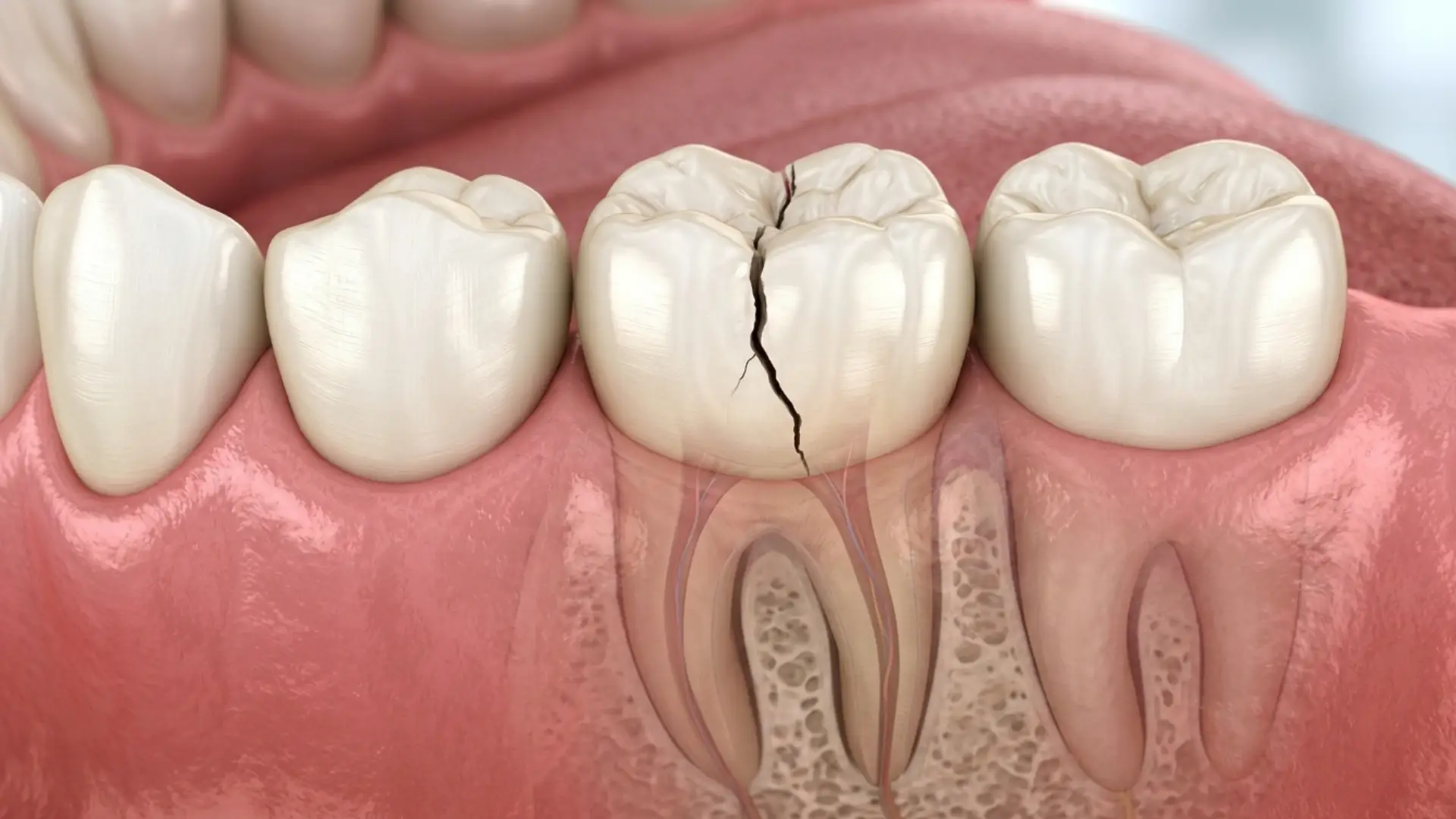 3D dental illustration showing a cracked tooth with a visible fracture.